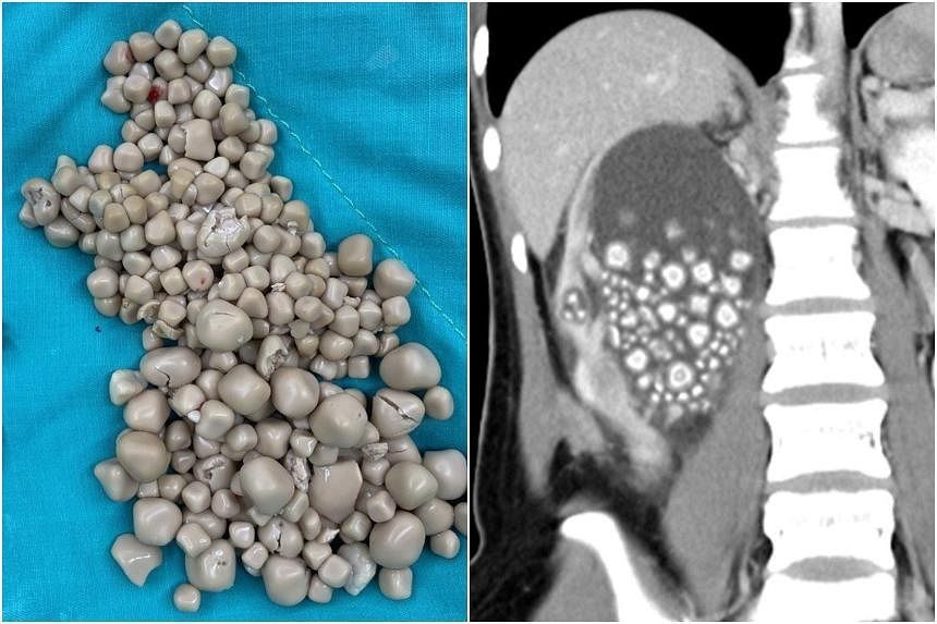 Doctors Remove 300 Kidney Stones from Taiwanese Women with Fondness for Bubble Tea